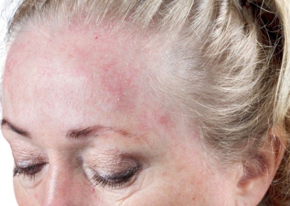 Behandeling, en bij een droge huid Dermadiq huidtherapeuten
